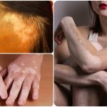 5 mẹo chữa bạch biến dân gian vẫn truyền tai nhau