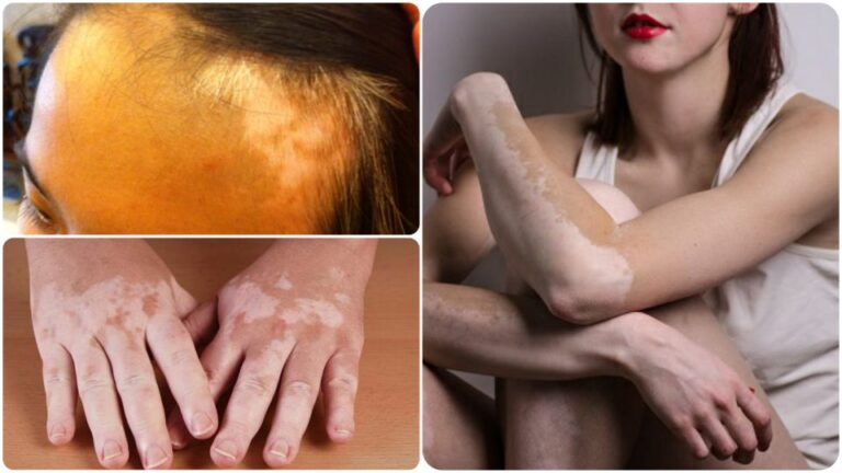 5 mẹo chữa bạch biến dân gian vẫn truyền tai nhau