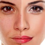 Đại cương và nguyên nhân gây bệnh sạm da