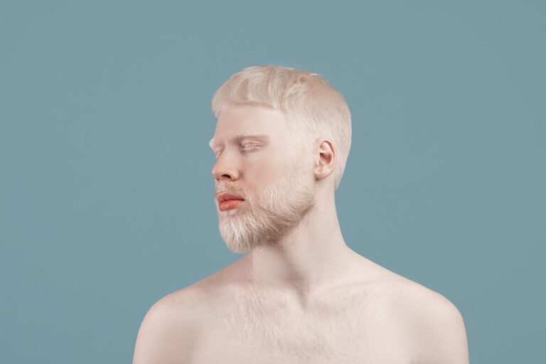 Đại cương về bệnh bạch tạng