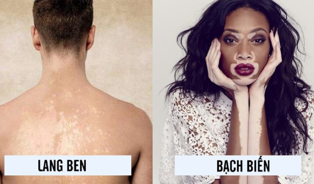 Phân biệt bệnh bạch biến và bệnh lang ben
