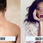 Phân biệt bệnh bạch biến và bệnh lang ben