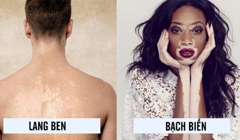 Phân biệt bệnh bạch biến và bệnh lang ben