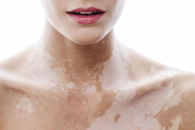 Đại cương và nguyên nhân gây bệnh bạch biến