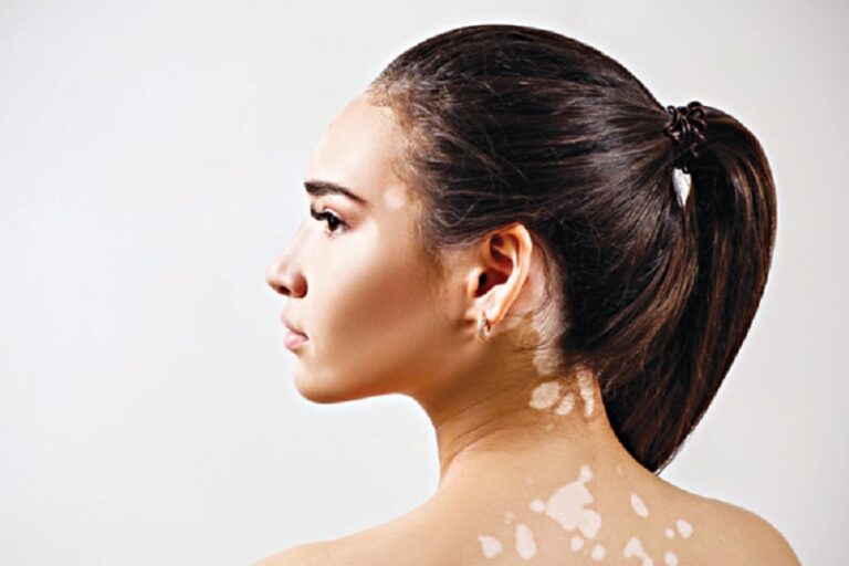 Chẩn đoán và điều trị bệnh bạch biến