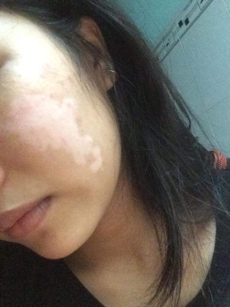 Bệnh bạch biến có lây không? 2 Bệnh bạch biến có lây không?