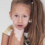 Bệnh bạch biến có tự khỏi không