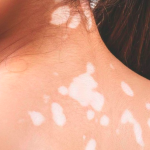 Các câu hỏi thường gặp trong quá trình chữa bệnh bạch biến phần 1