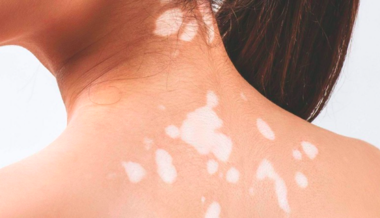 Bệnh bạch biến, nguyên nhân và cách chữa 5 Các câu hỏi thường gặp trong quá trình chữa bệnh bạch biến phần 1