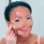 Bệnh Bạch Biến Có Chữa Được Không