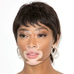 Bệnh Lang Trắng và Bệnh Mất Sắc Tố Da Bạch Biến (Vitiligo)