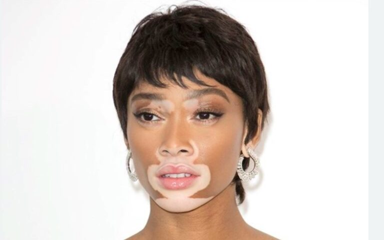 Bệnh Lang Trắng và Bệnh Mất Sắc Tố Da Bạch Biến (Vitiligo) 2 Bệnh Lang Trắng và Bệnh Mất Sắc Tố Da Bạch Biến (Vitiligo)