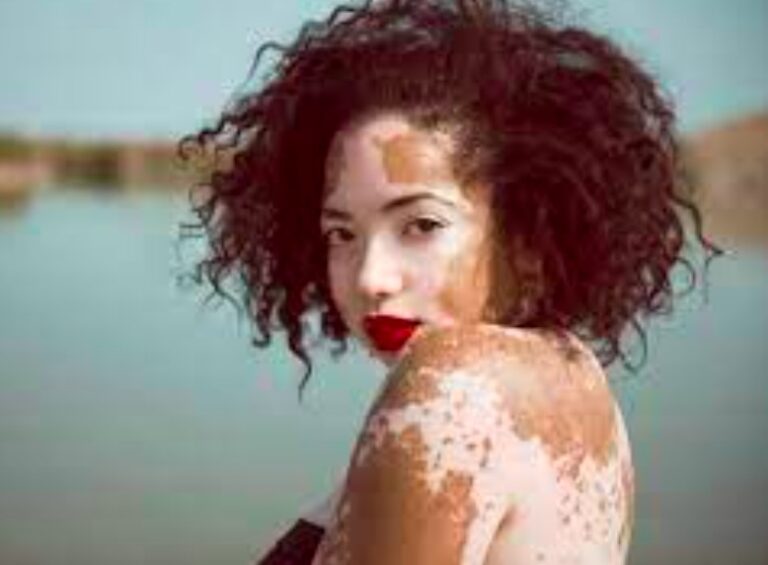 Hình Ảnh Ban Đầu Của Bệnh Bạch Biến 3 Hình Ảnh Ban Đầu Của Bệnh Bạch Biến