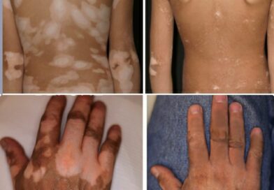 benh-bach-bien-vitiligo