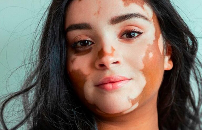 Thuốc Trị Bạch Biến Tận Gốc 4 Thuốc Trị Bạch Biến Tận Gốc