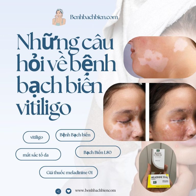 Những câu hỏi về bệnh bạch biến vitiligo 5 Nhung cau hoi ve benh bach bien vitiligo