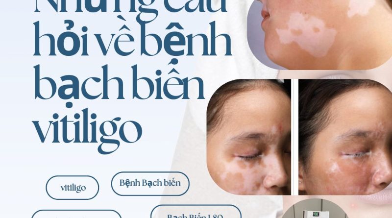 Nhung cau hoi ve benh bach bien vitiligo